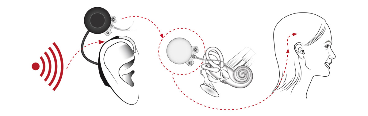 Grafik Cochlea-Implantat
