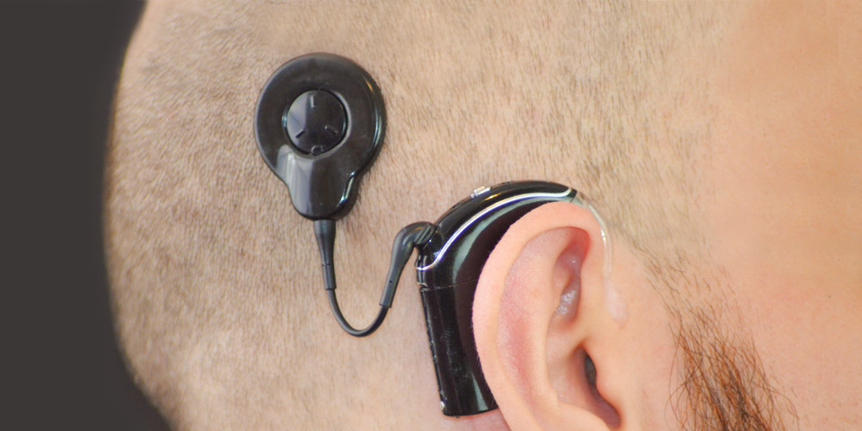 Cochlea-Implantat im Detail